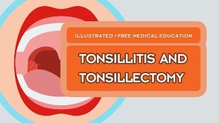 What is Tonsillitis amp Tonsillectomy [upl. by Aidnyc]