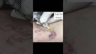 Varicose veins treatment dermatology medstudent medschool skincare spiderveins [upl. by Ewell]