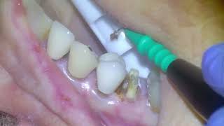 26 Major decay under crown leads to root canal [upl. by Cyrillus]