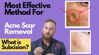 How To Treat DEEP ACNE SCARS  What is SUBCISION [upl. by Mccarty]