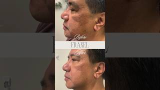 Before and after Fraxel treatment laser medispa danvilleca [upl. by Apurk957]