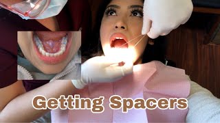 Getting Spacers Before Braces  WHAT TO EXPECT  VLOG 1 [upl. by Aivekal]