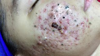 Big Cystic Acne Blackheads Extraction Blackheads amp Milia Whiteheads Removal Pimple Popping  65587 [upl. by Zak260]