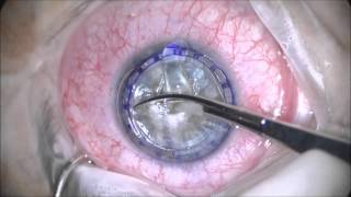 Deep Anterior Lamellar Keratoplasty [upl. by Soinotna]