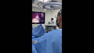 EVALUACION DE LA PERFUSION TISULAR EN GASTRECTOMIA VERTICAL EN MANGA LAPAROSCOPICA HD 1080p [upl. by Shaikh115]