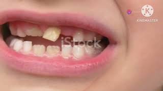 Teeth splintingLoose teeth treatmentSinghs Dental Clinic DhanbadDentist in DhanbadPeriodontist [upl. by Ysle]