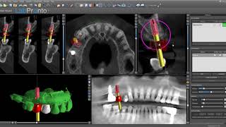 Routine Implant Planning in Blue Sky Plan v 459 [upl. by Way]