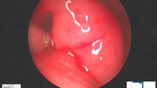 dilatation trompe dEustache  tuboplastie  balloon dilation of auditory tube [upl. by Mauceri811]