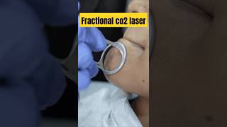 Fractional CO2 laser for acne scar removal co2laser [upl. by Araht]