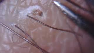 SCAB reveals ingrown hair which is then removed 59 [upl. by Llerref]