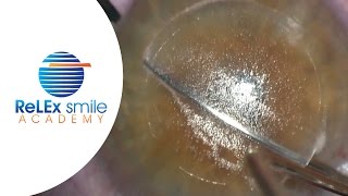 ReLEx smile Academy Dissection of lenticule Step 10 amp 11 [upl. by Garneau265]