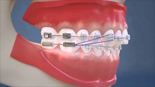 Class II Elastics  Lateral View HD Edition [upl. by Brittani]