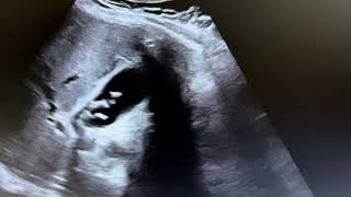 Ultrasound of calculus cholecystitis [upl. by Adnawot]