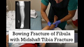 Bowing Fracture of Fibula and Midshaft Tibia Fracture [upl. by Ajiat]