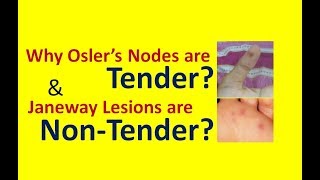 Why Oslers Nodes are Painful while Janeway Lesions are Painless [upl. by Eeldarb]