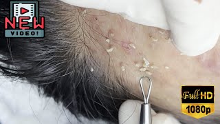 Satisfying SkinCare Blackheads Acne Extraction Video With Dr Thuy QGSPA Date11112024 [upl. by Hepzi]