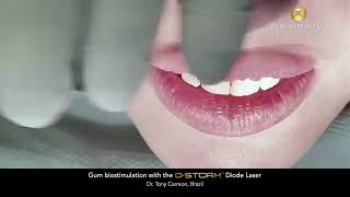 Gum biostimulation with the DStorm™ Diode Laser [upl. by Rabah]