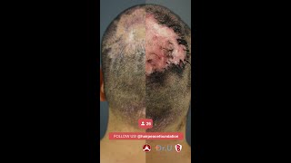 Folliculitis Decalvans Before and After  Dr U [upl. by Marguerite289]