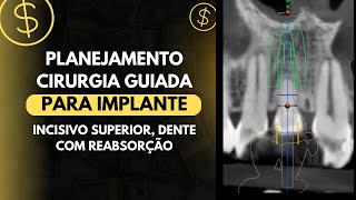 PLANEJAMENTO CIRURGIA GUIADA PARA IMPLANTE INCISIVO SUPERIOR DENTE COM REABSORÇÃO [upl. by Natanoy]