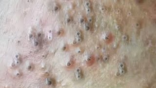 Blackheads amp Whiteheads Satisfying Removal 0072 [upl. by Kazim244]