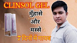 Clinsol gel Use and its side effects  Clinsol gel cream for pimple and wats use in hindi [upl. by Recha]