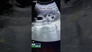 Kidney stoneRenal stoneUreteric stone stone kidney ultrasound reels shorts ultraradiology [upl. by Ecitsuj]