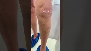 Cirurgia de varizes com laser [upl. by Isbella544]