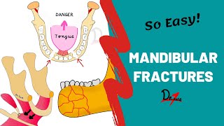 Mandibular Fractures  Basics  DENTAL NOTES [upl. by Leanna]