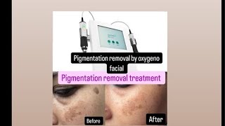 Pigmentation Pigmentation removal treatment pigmentation removal treatment by oxygeno facial [upl. by Soracco]