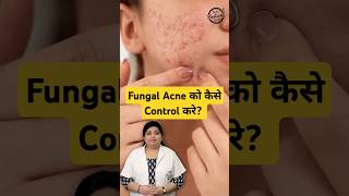 How to treat Fungal Acne on face  Fungal Acne Treatment fungalacne acne skincare shorts [upl. by Asil]