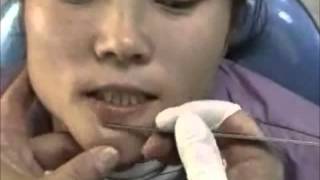 How to scrape the chin for demodex mites [upl. by Beauvais]