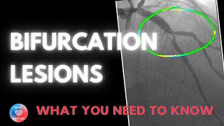 Bifurcation Coronary Lesions [upl. by Aara]