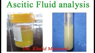 Ascitic fluid analysis تحليل السائل البريتوني [upl. by Kennard]