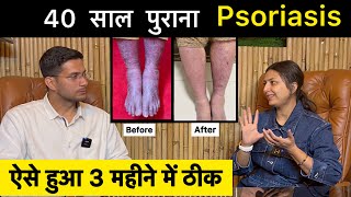 Psoriasis Treatment In Hindi Ft upasanakiduniya  Skin Disease  Himanshu Bhatt [upl. by Llenrep]