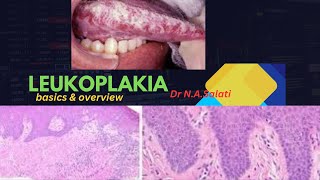 Leukoplakia Differential Diagnosis [upl. by Doughty]