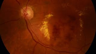 BRANCH RETINAL VEIN OCCLUSION amp GLAUCOMA [upl. by Let]