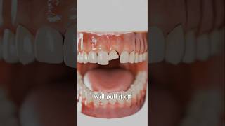 How Dental Implants Work 😱 shorts viral [upl. by Mailiw]