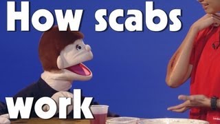 How Scabs Work  Kids Health  The Friday Zone  WTIU  PBS [upl. by Kiri]