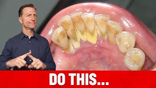 The 1 Top Remedy for Dental Plaque TARTAR [upl. by Levon]