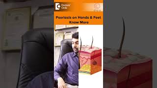 PSORIASIS on Hands amp Feet Palmoplantar Psoriasis TreatmentDrRajdeep MysoreDoctors Circleshorts [upl. by Read]