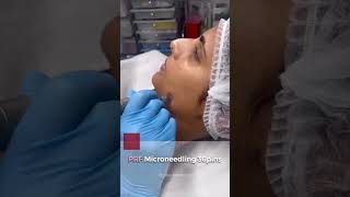 Bio Filler PRF Gel under eyes treatment [upl. by Klusek]