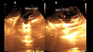 Bilateral hydro nephrosis  Bilateral dilated ureter  Renal Ultrasonography [upl. by Gena]