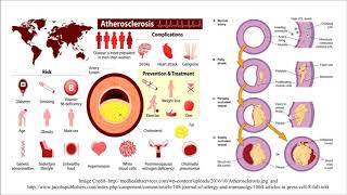 Atherosclerosis  Causes amp Risk Factors Associated With Atherosclerosis  Atheroma  Hyperlipidemia [upl. by Irrac]