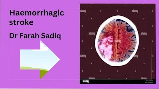 haemorrhagic  stroke  subarachnoid hemorrhage subdural extradural hematoma [upl. by Mihar889]