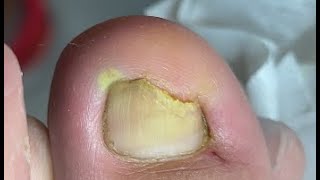 Best and quickest infected nail professional treatment [upl. by Malkin778]