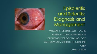 Scleritis and Episcleritis Vincent de Luise MD [upl. by Brian]