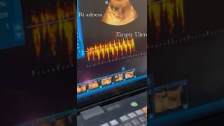 Unruptured Live Ectopic Pregnancy ectopicpregnancy ultrasonography [upl. by Valerle]