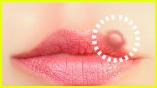 10 Naturheilmittel gegen Lippenherpes [upl. by Redyr674]