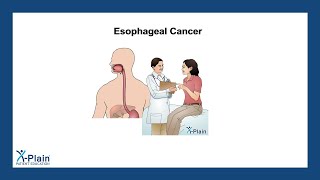 Esophageal Cancer [upl. by Aidan592]