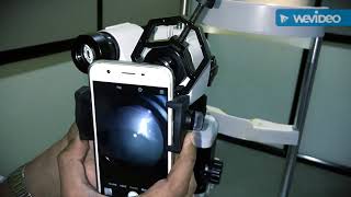 Smartphone Slitlamp Microscope Adapter [upl. by Coad317]